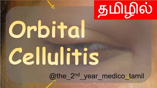 ORBITAL CELLULITIS  தமிழில்  Ophthalmology  MBBS [upl. by Jenelle]