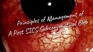 Principles of management of a Post SICS encysted Sub Conjunctival Bleb [upl. by Sukin]