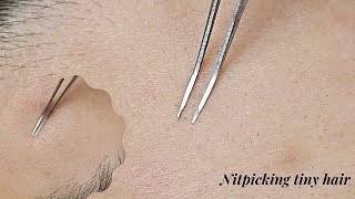 NITPICKING THE TINIEST face hair while in Deep Sleep 😴  ASMR [upl. by Brogle]