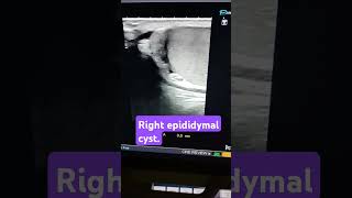 testicular ultrasoundright epididymal cyst [upl. by Ora]