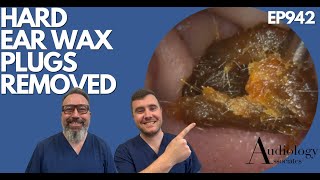 HARD EAR WAX PLUGS REMOVED  EP942 [upl. by Josepha]