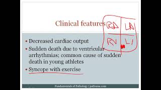 8 6 Cardiomyopathy 8 7 Cardiac Tumors [upl. by Larrie]