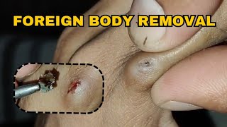 Foreign Object Removal From Finger  ASMR  Foreign Body Removal [upl. by Choo]