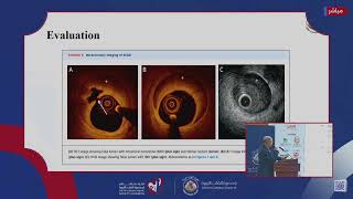 Day 3 Interventional Cardiology II [upl. by Wasson104]