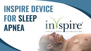 Inspire Device for Sleep Apnea [upl. by Akeimahs]