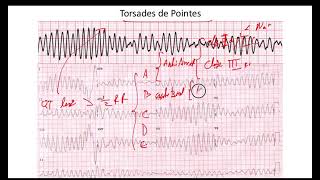 Torsades de Pointes EKG [upl. by Mairym152]