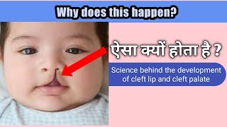 Cleft lip and Cleft Palate  कटे होंठ कैसे विकसित होते हैं   Eduplast Pro  Prasad Ganta [upl. by Loos]