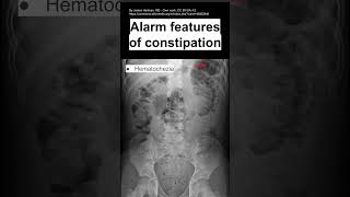 Alarm features of constipation [upl. by Eeraj]