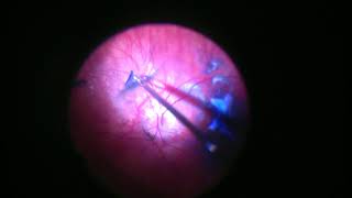 Difficult Posterior Hyaloid [upl. by Dnalel]