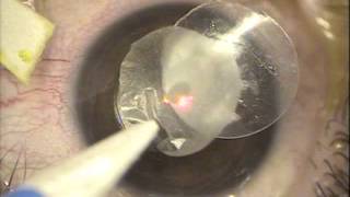 Amniotic membrane disc adjunct to postCXL healing for keratoconus kanellopoulos MD [upl. by Maurer47]