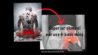 Superior Cluneal Nerve Entrapment and Back Mice two important pieces in the low back pain PUZZLE [upl. by Tracy]