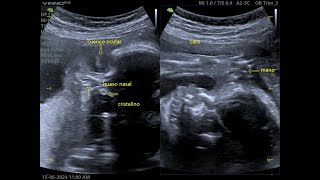 CARITA FETAL A LAS 29 SEMANAS DE GESTACIÓN EMBARAZO NORMAL [upl. by Ellainad]