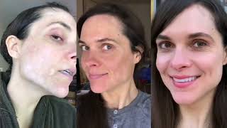 100 Vitiligo Recovery In 5 Months  Ashleighs Success Story  VITILIGO ORGANICS™️ Review [upl. by Ardnac]