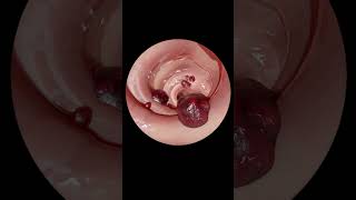 How gastrointestinal endoscopy is done [upl. by Nnel]