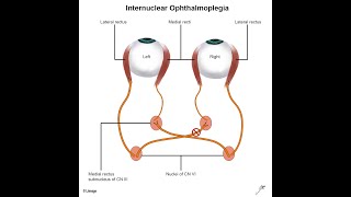 Cause of Opthalmoplegia  Lesion to 3rd 4th 6th cranial nerve [upl. by Kinsler]