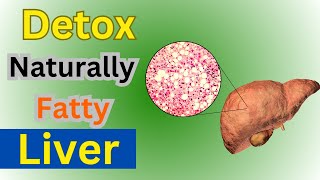 Reverse Fatty Liver in 3 Weeks Naturally  Liver detoxification [upl. by Damle]