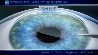 Intervento Laser Occhi Come Funziona [upl. by Paten]