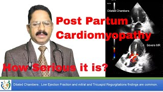 Post Partum Cardiomyopathy Treatment Pregnant Women Complications and Treatments [upl. by Quintina]