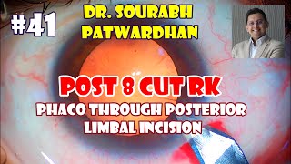 Commented 41 Post RK Radial keratotomy Phaco Dr Sourabh Patwardhan [upl. by Hnad]