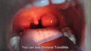 Examination Of Tonsils [upl. by Aicileb]