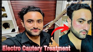 Electro Cautery Face Treatment  For Skin tags Removal facetreatment vlog viralvideo viralvlogs [upl. by Idnahc814]