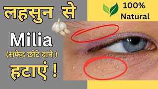 Milia Removal  आँखों के नीचे सफेद दाने हटाने का असान उपाय  Natural Home Remedy [upl. by Bible]