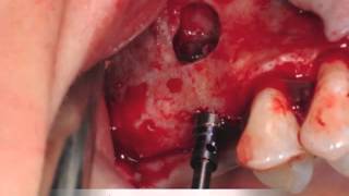 Single stage dental implant and sinus lift bone grafting [upl. by Wohlert]