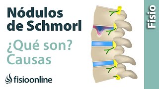 Nódulos de Schmorl  ¿Qué son y cómo sucede [upl. by Eenhat]