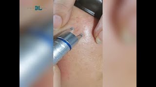 980 nm vein removal laser system [upl. by Eanom166]