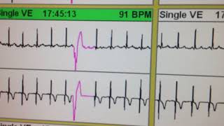 ECG 111 HOLTER CON EXTRASISTOLES VENTRICULARES BIGEMINADAS Y PAREADAS ASOCIADAS ISQUEMIA SILENCI [upl. by Bury]