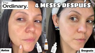 The Ordinary Skincare Ácido Hyalurónico Retinol y Niacinamida por 4 MESES vean el ANTES y DESPUÉS [upl. by Arabella]