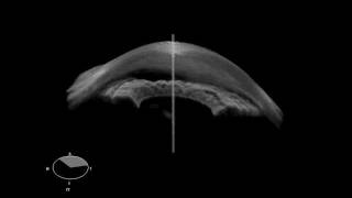 SS1000 Anterior Chamber OCT 3D View [upl. by Anuaik]