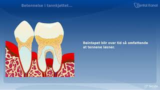 Periodontitt [upl. by Sidonia]