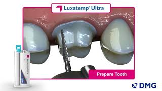 Luxatemp Ultra Rated 1 in Flexural Strength [upl. by Esirehs722]