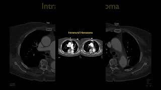 Intramural Hematoma [upl. by Audri]