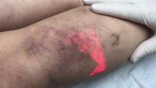 Angiogenesis Complication After Sclerotherapy [upl. by Candi683]