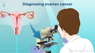 Diagnosing Ovarian Cancer [upl. by Ann984]