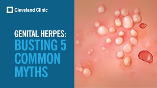 Busting 5 Myths About Genital Herpes [upl. by Adnuahsar]