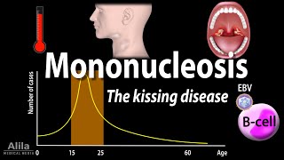 Infectious Mononucleosis Mono  the Kissing Disease Animation [upl. by Sabelle]