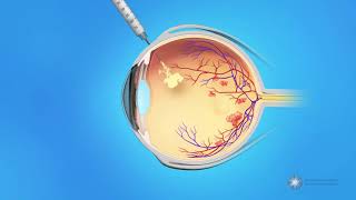 Eye Injections for Central Retinal Vein Occlusion CRVO [upl. by Pevzner]