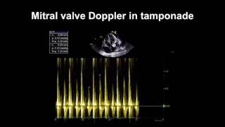 Echocardiography Essentials Detecting pericardial effusions [upl. by Bahr]