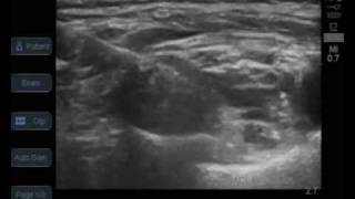 ultrasound guided supraclavicular brachial plexus block [upl. by Anem846]