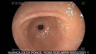 ENDOSCOPIA DIGESTIVA ALTA [upl. by Whiney]