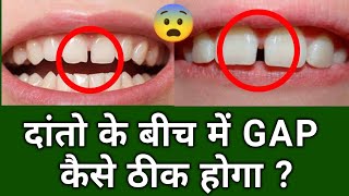 How to Permanently Fix Gap in between Front Teeths 🦷 🔧 [upl. by Roley754]