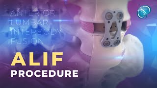 What is Anterior Lumbar Interbody Fusion  ALIF [upl. by Tivad]