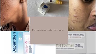 How I cleared my acne with orataneside effectscost amp more oratane cerave nivea [upl. by Holms]