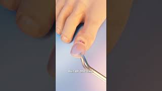 How Toenail Removal Works 😳 [upl. by Yentuoc]