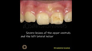 Enamel Hypoplasia Management [upl. by Hiroshi60]