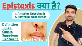 Epistaxis in Hindi  Causes Symptoms and Treatment of Epistaxis  Nasal Bleeding [upl. by Wrdna]