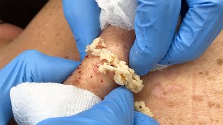 Stubborn Sac and Cyst Removal  CONTOUR DERMATOLOGY [upl. by Beebe]